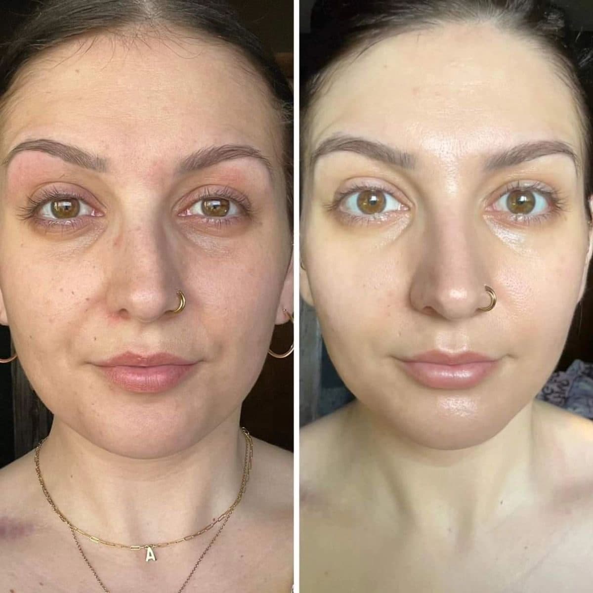 Skin treatment before photo