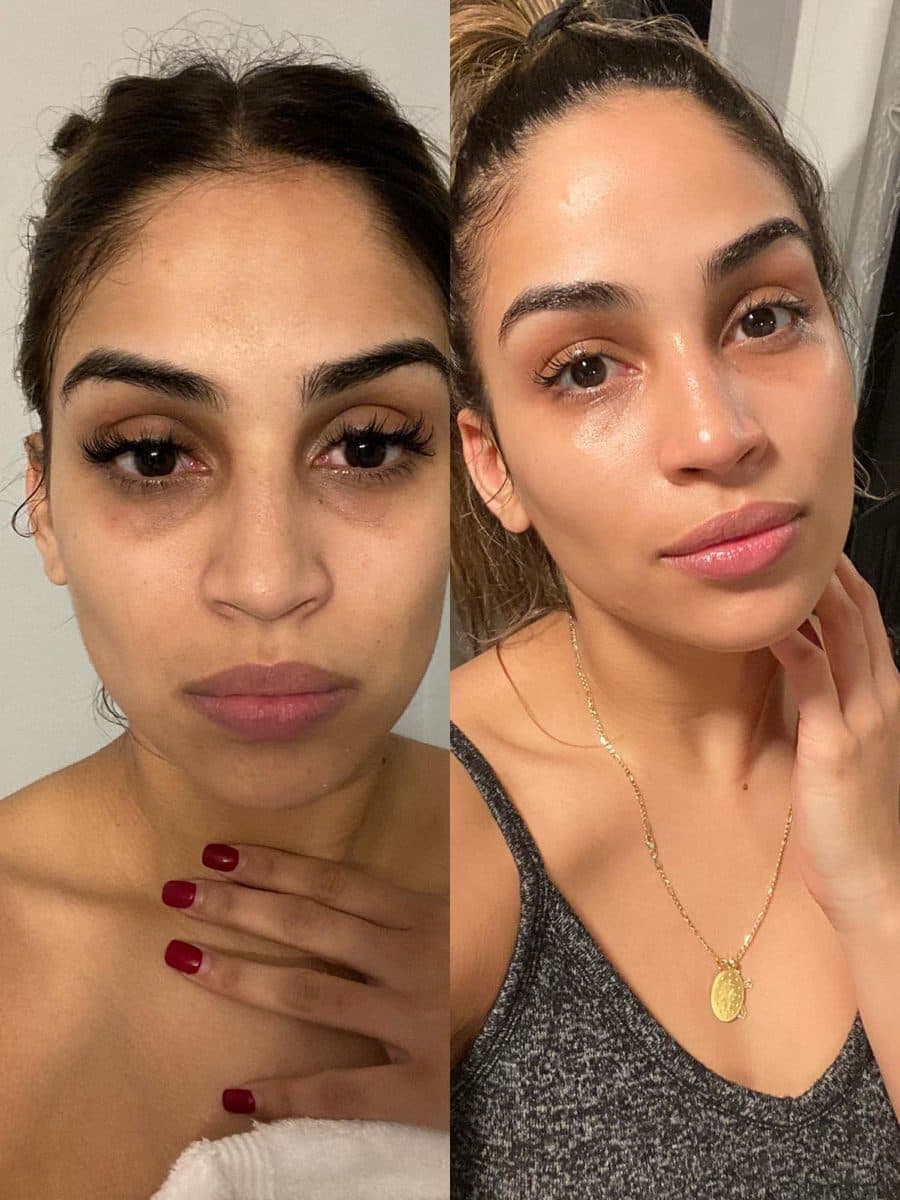 Skin treatment after photo
