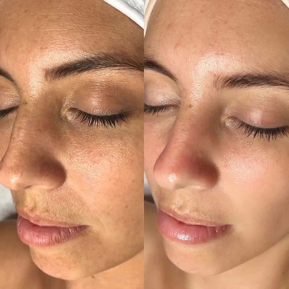 Dull skin before photo