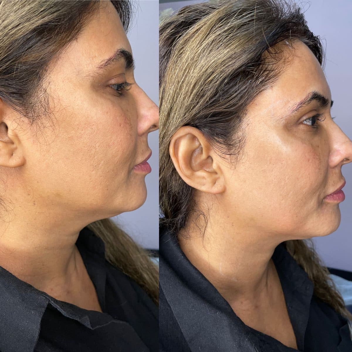 Glowing skin after photo